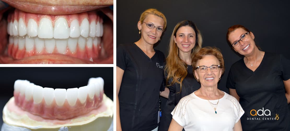 Implantologie — caz clinic înainte și după, Smile by Ada, Sector 2 București