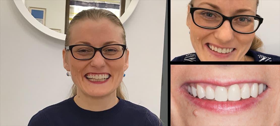 Reabilitare completă — caz clinic înainte și după, Smile by Ada, Sector 2 București
