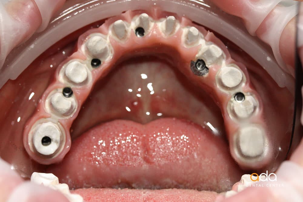Reabilitare completă — imagine din tratament, Smile by Ada, Sector 2 București — foto 2
