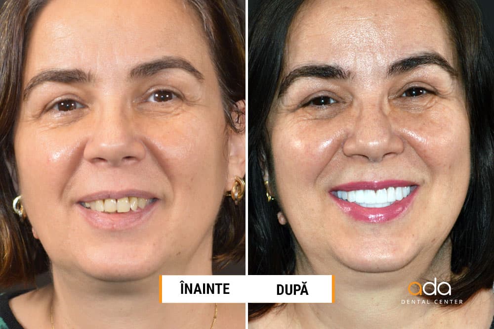 DSD — Important în orice refacere a zâmbetului — imagine 1