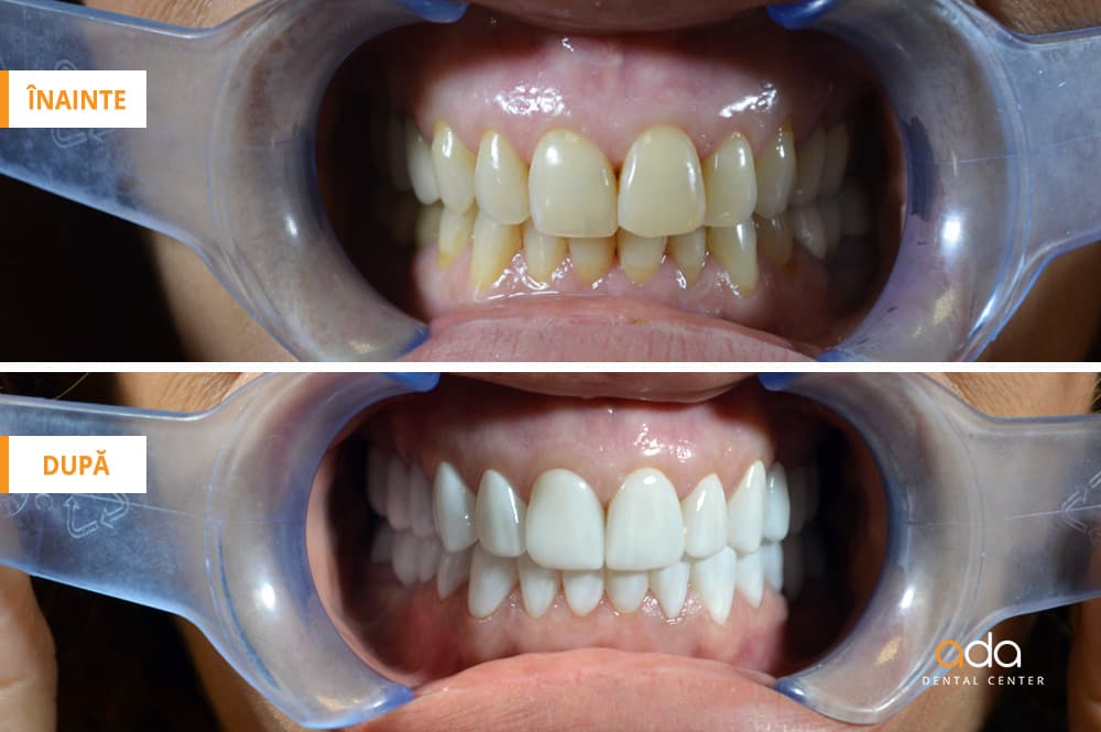 Restaurare estetică dento-facială — imagine 1