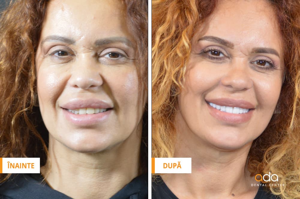 Restaurare estetică dento-facială — imagine 2