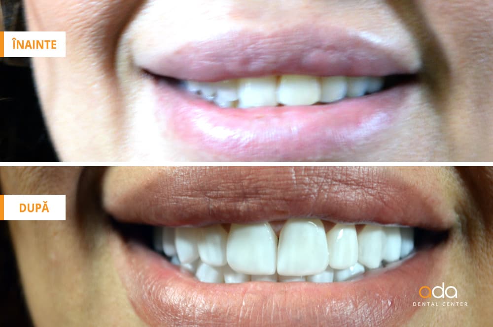 Restaurare estetică dento-facială — imagine 3