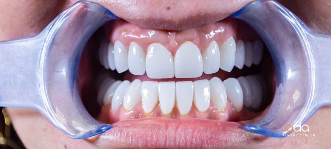 Reabilitare completă — imagine din tratament, Smile by Ada, Sector 2 București — foto 1