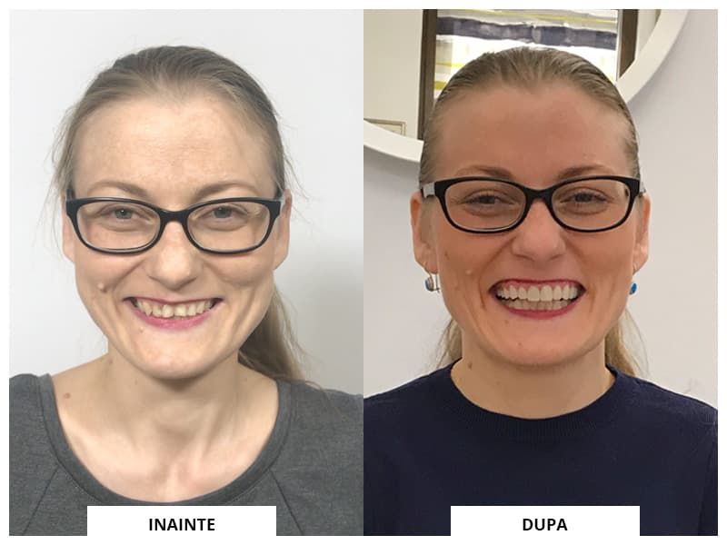 Reabilitare completă — imagine din tratament, Smile by Ada, Sector 2 București — foto 2
