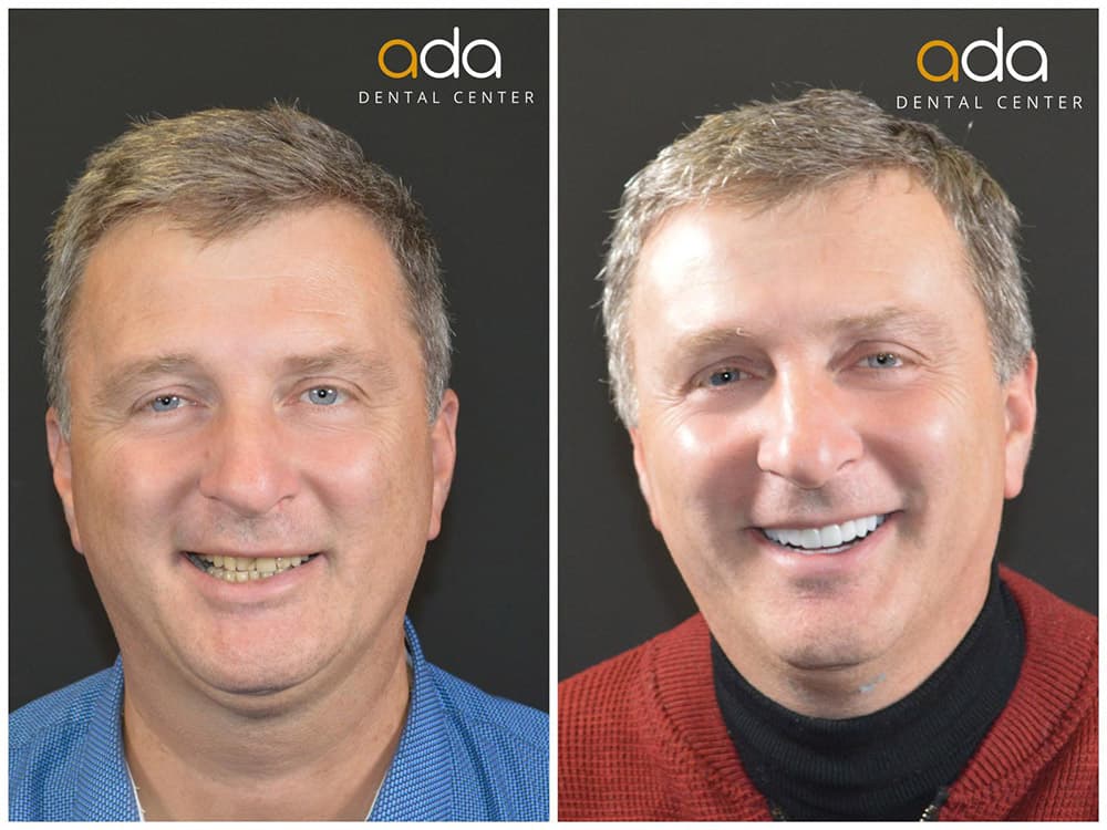 Reabilitare completă — imagine din tratament, Smile by Ada, Sector 2 București — foto 1