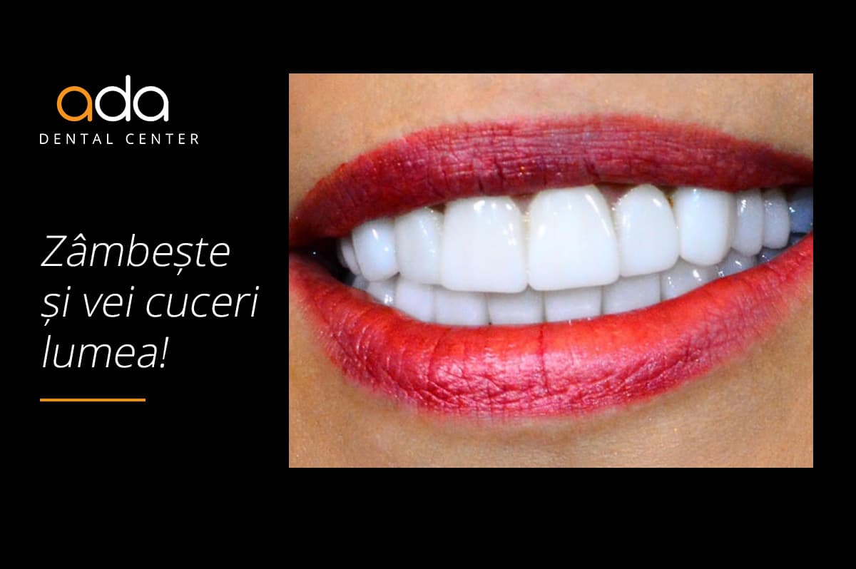 Digital Smile Design — imagine din tratament, Smile by Ada, Sector 2 București — foto 3
