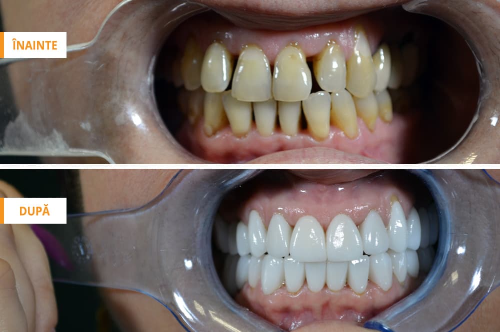 Reabilitare completă — imagine din tratament, Smile by Ada, Sector 2 București — foto 1