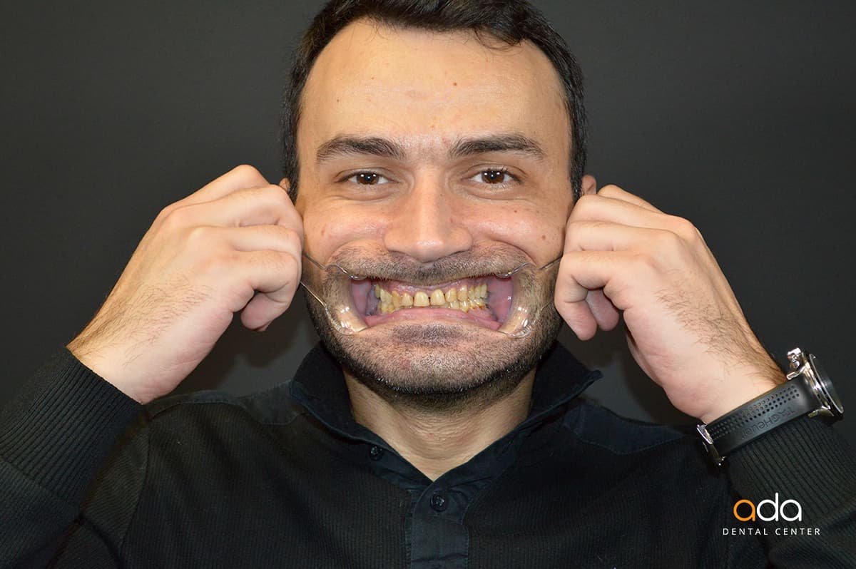 Coroane zirconiu — imagine din tratament, Smile by Ada, Sector 2 București — foto 5