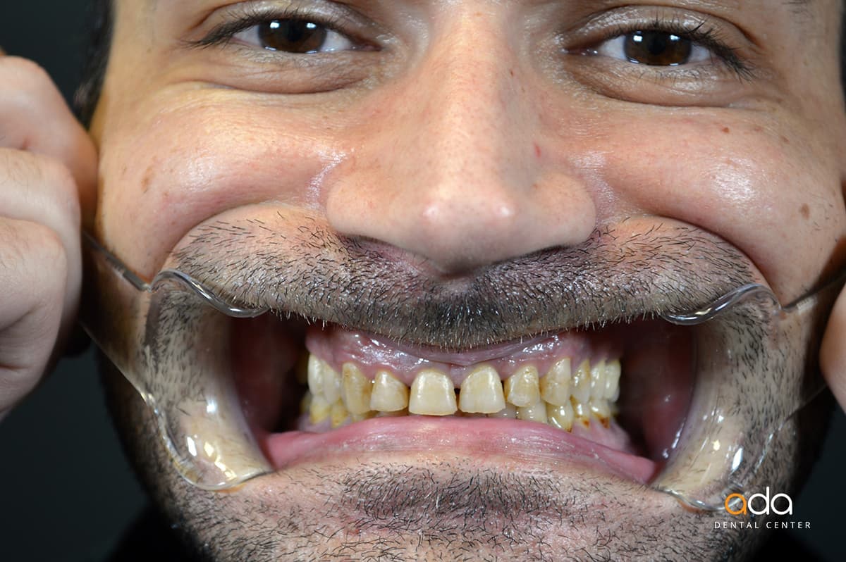 Coroane zirconiu — imagine din tratament, Smile by Ada, Sector 2 București — foto 6