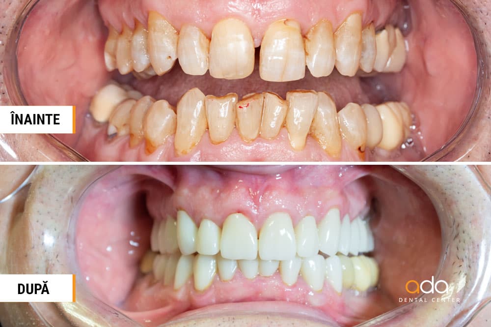 Estetică dentară — imagine din tratament, Smile by Ada, Sector 2 București — foto 1