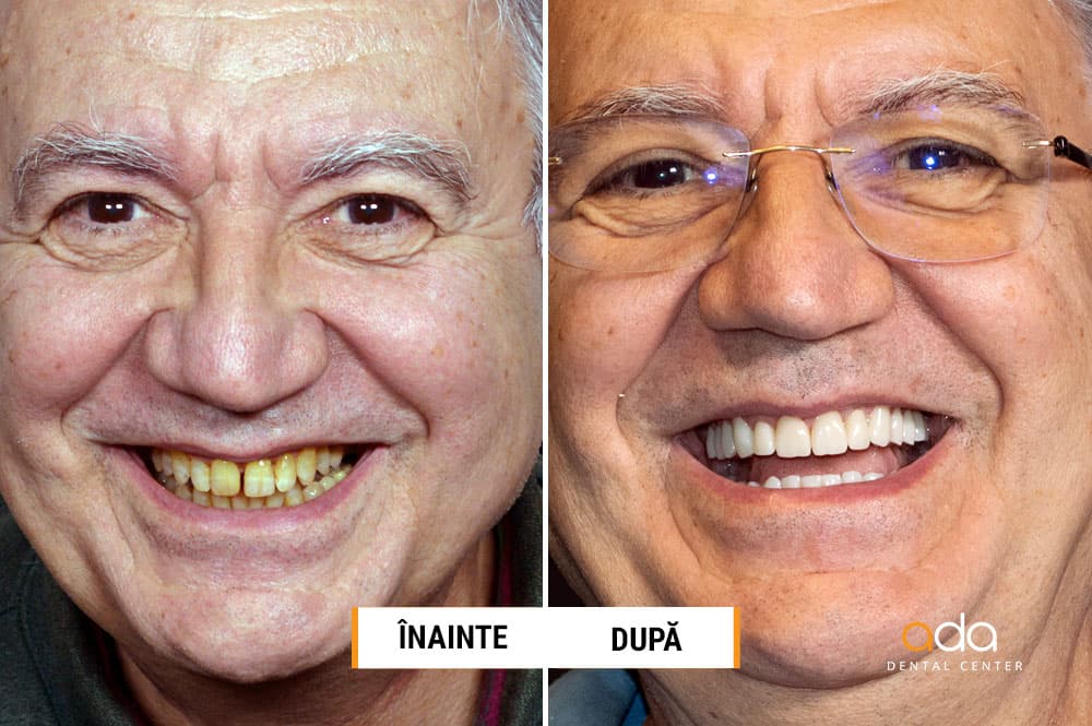 Estetică dentară — imagine din tratament, Smile by Ada, Sector 2 București — foto 2