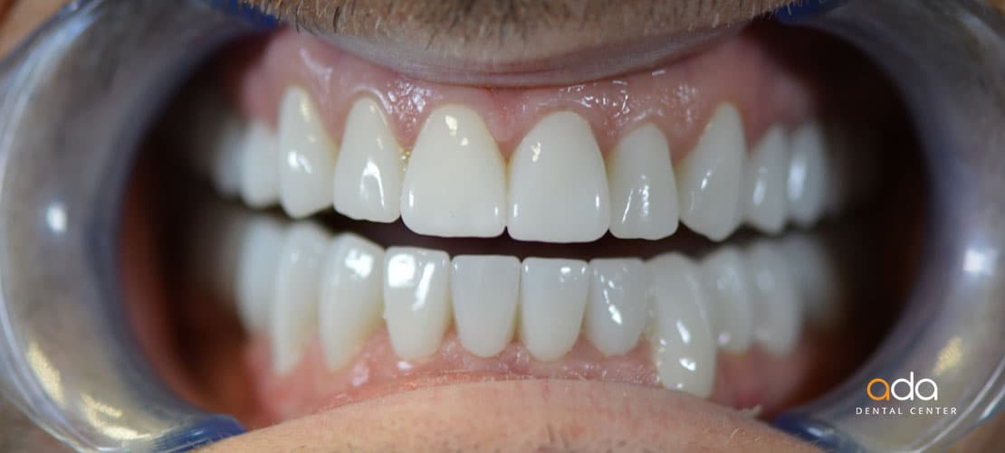 Reabilitare completă — imagine din tratament, Smile by Ada, Sector 2 București — foto 2