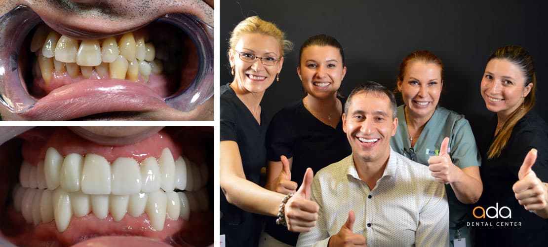 Digital Smile Design — caz clinic înainte și după, Smile by Ada, Sector 2 București