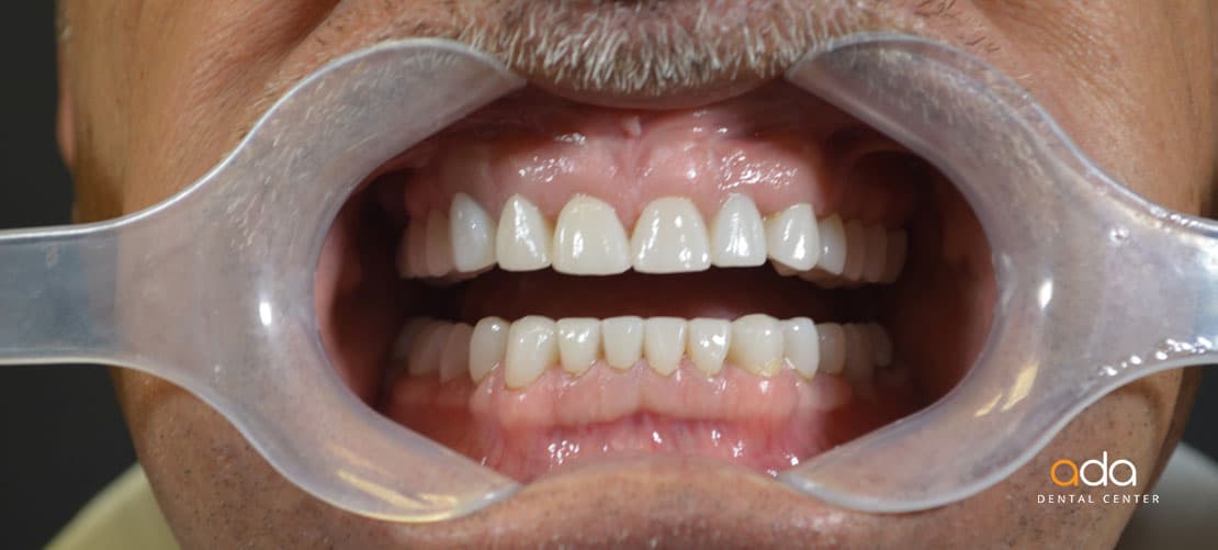 Digital Smile Design — caz clinic înainte și după, Smile by Ada, Sector 2 București