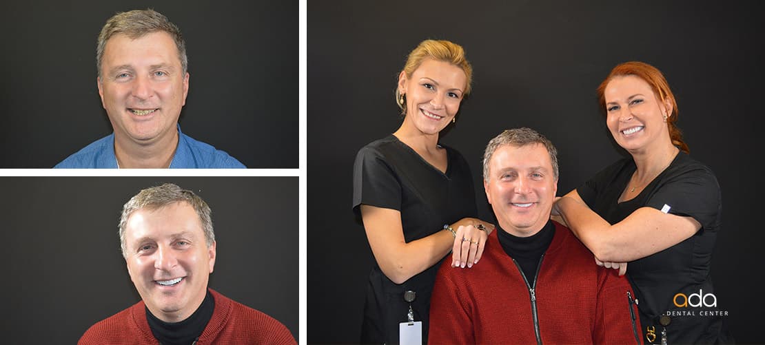 Reabilitare completă — caz clinic înainte și după, Smile by Ada, Sector 2 București