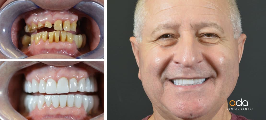 Digital Smile Design — caz clinic înainte și după, Smile by Ada, Sector 2 București