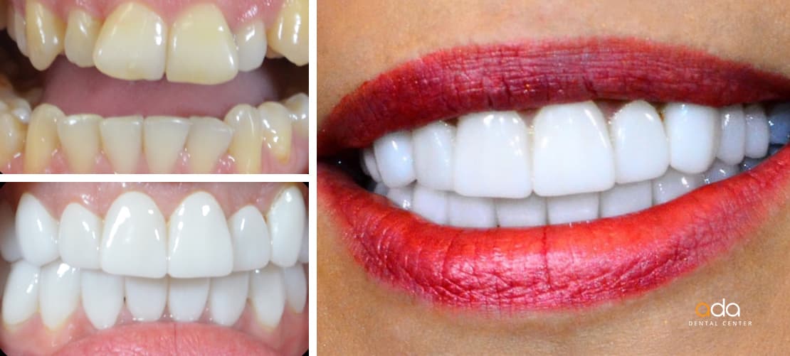 Digital Smile Design — caz clinic înainte și după, Smile by Ada, Sector 2 București