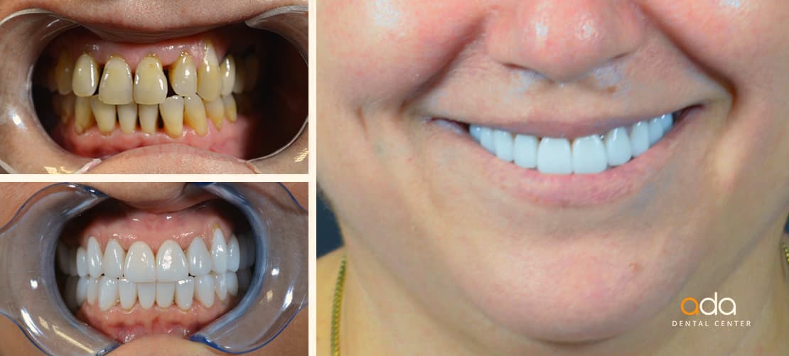 Reabilitare completă — caz clinic înainte și după, Smile by Ada, Sector 2 București