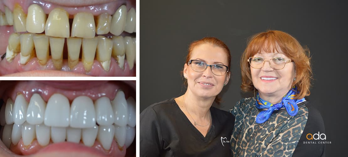 Reabilitare completă — caz clinic înainte și după, Smile by Ada, Sector 2 București