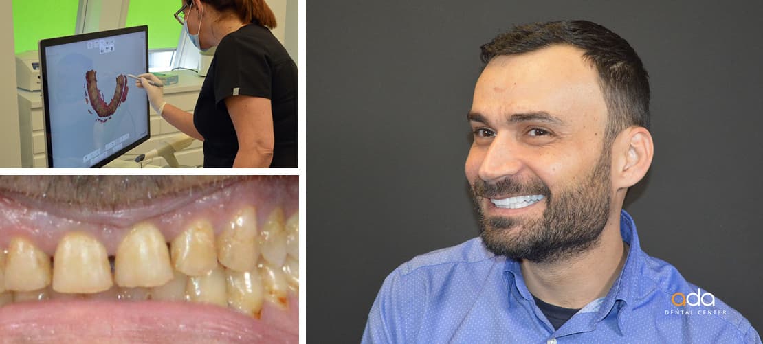 Coroane zirconiu — caz clinic înainte și după, Smile by Ada, Sector 2 București