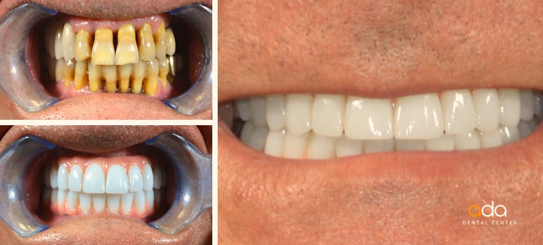 Implantologie — caz clinic înainte și după, Smile by Ada, Sector 2 București