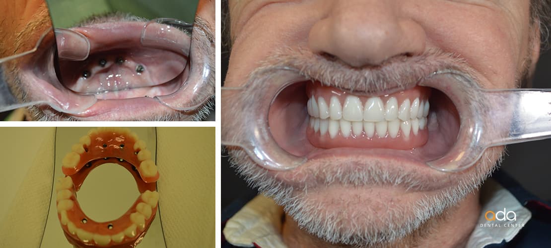 Parodontologie — caz clinic înainte și după, Smile by Ada, Sector 2 București