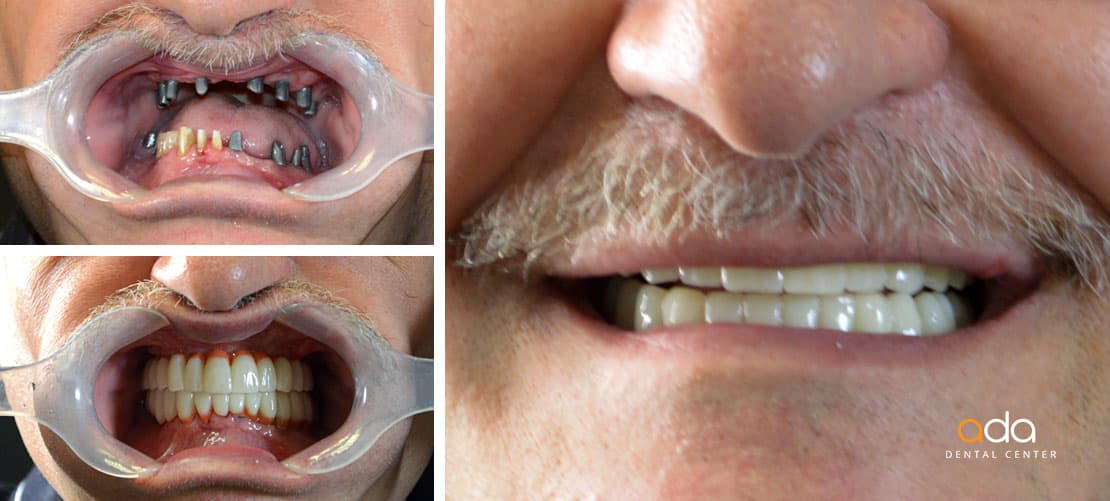Implantologie — caz clinic înainte și după, Smile by Ada, Sector 2 București