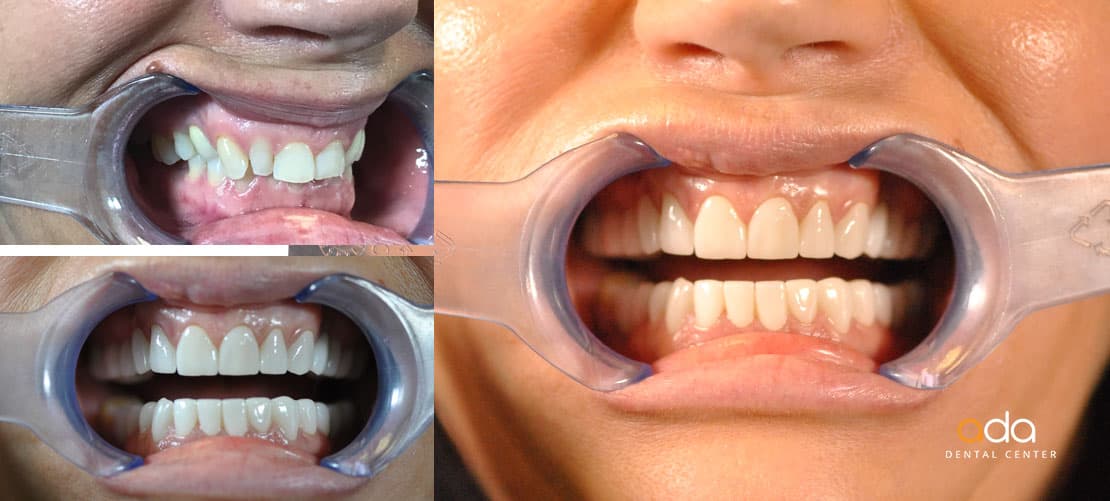 Implantologie — caz clinic înainte și după, Smile by Ada, Sector 2 București