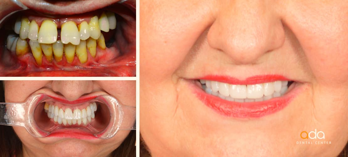 Reabilitare completă — caz clinic înainte și după, Smile by Ada, Sector 2 București