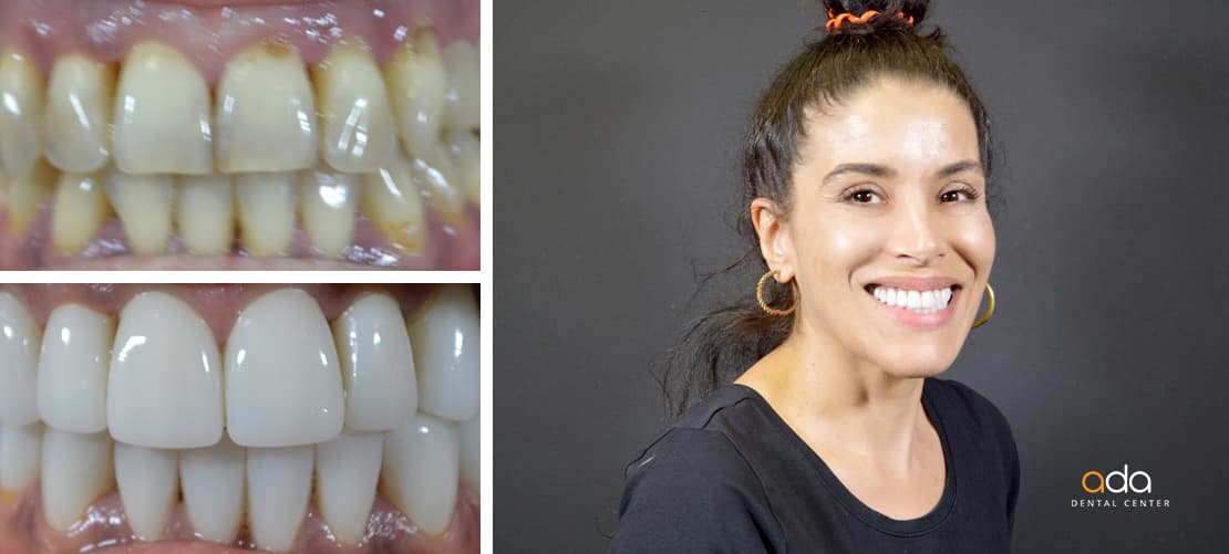 Reabilitare completă — caz clinic înainte și după, Smile by Ada, Sector 2 București