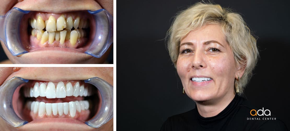 Digital Smile Design — caz clinic înainte și după, Smile by Ada, Sector 2 București