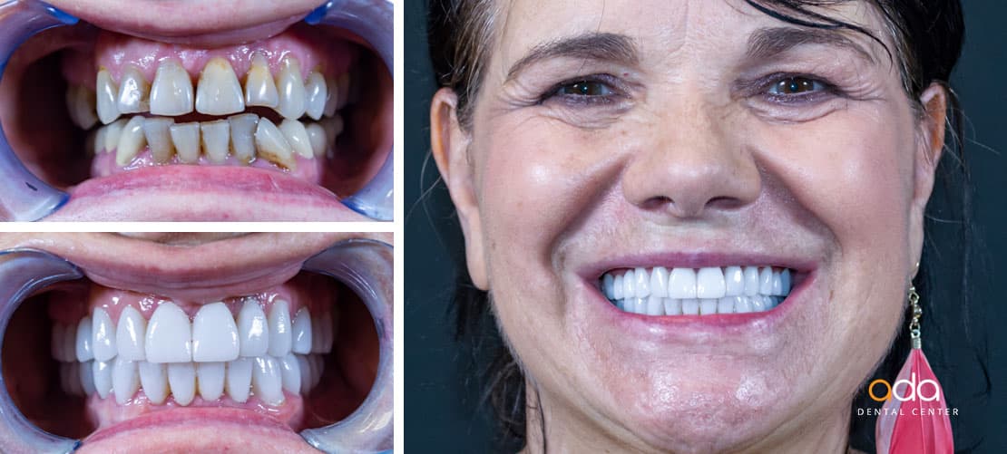 Reabilitare completă — caz clinic înainte și după, Smile by Ada, Sector 2 București