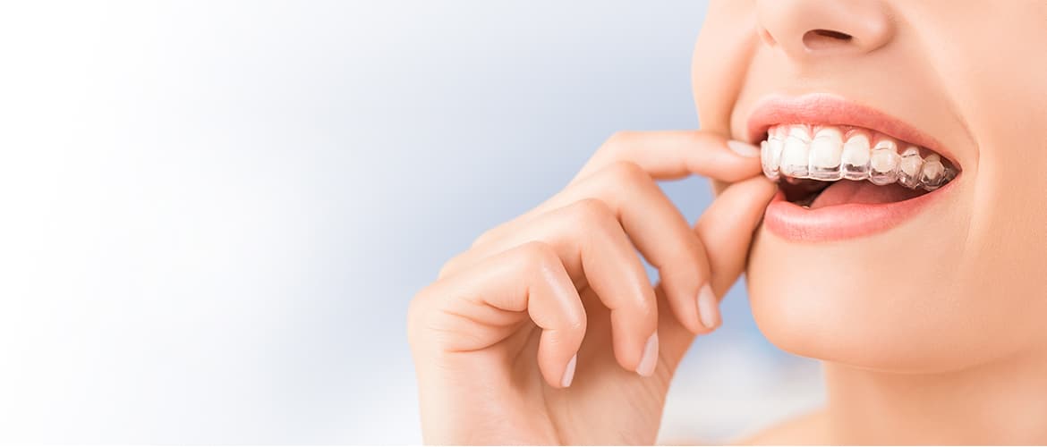 Invisalign: Tratamentul ortodontic fără brackeți