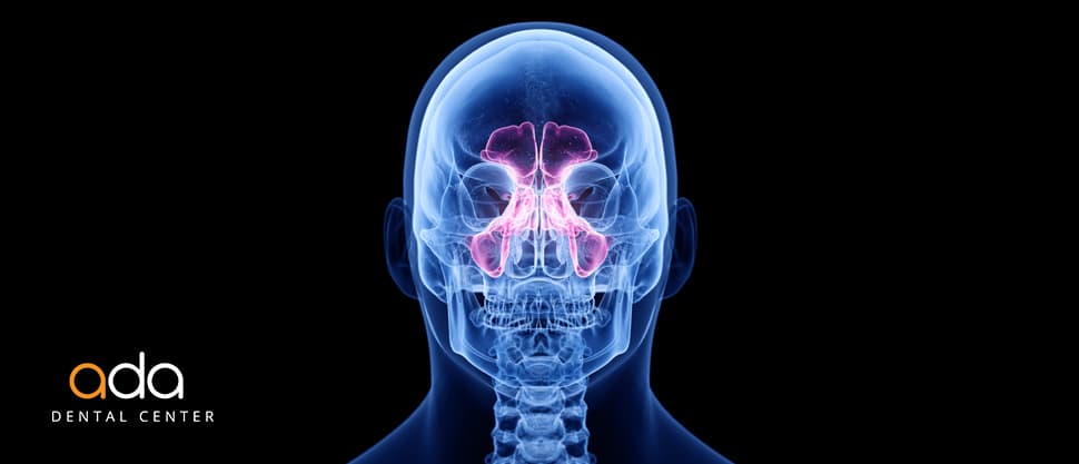 Sinus Lift - membrana din sinus creeaza singura os!