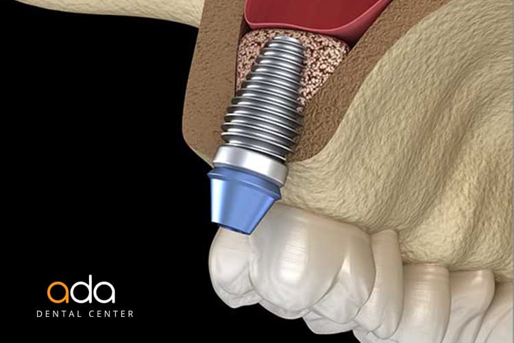 Sinus lift: ce este, la ce ajută și cum este resimțit de pacient