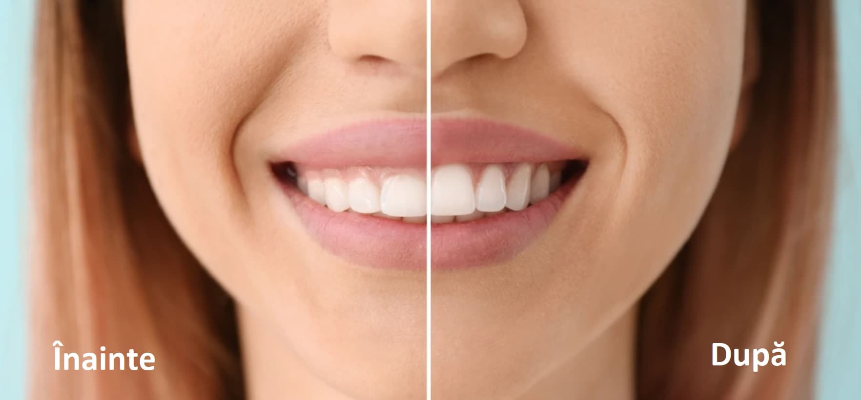 Gingivoplastia: ce este, cui se adresează și cum se realizează această procedură laser