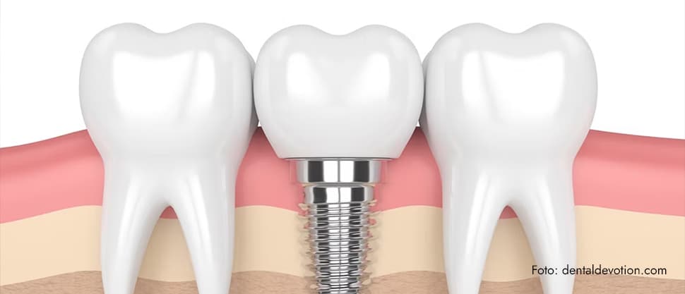Implanturile dentare la pacienții cu diabet