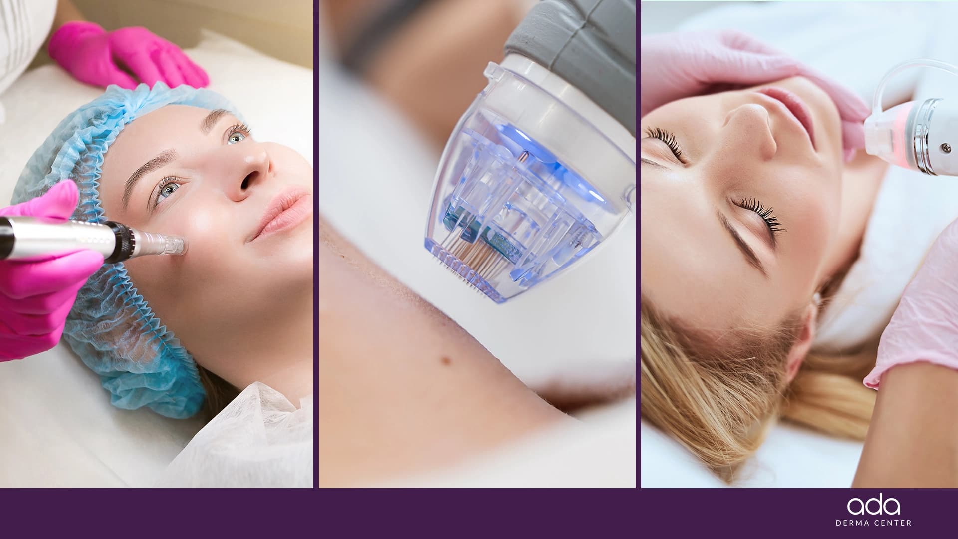 Microneedling: beneficii, procedură și rezultate