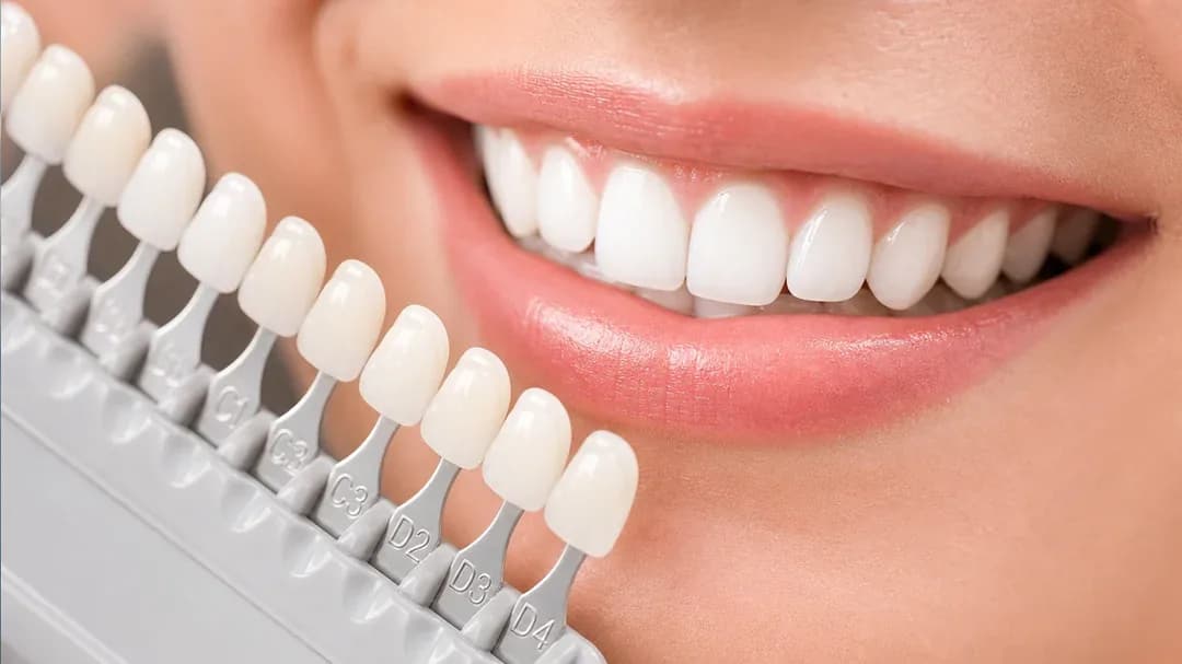 Cât costă albirea dentară profesională la clinică (2026)