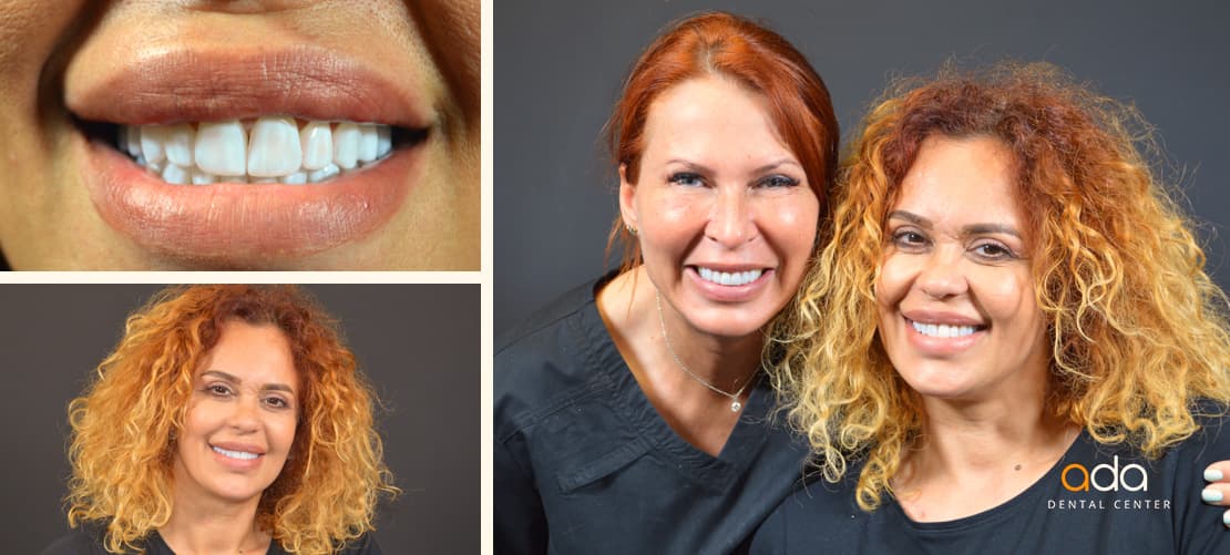 Restaurare estetică dento-facială