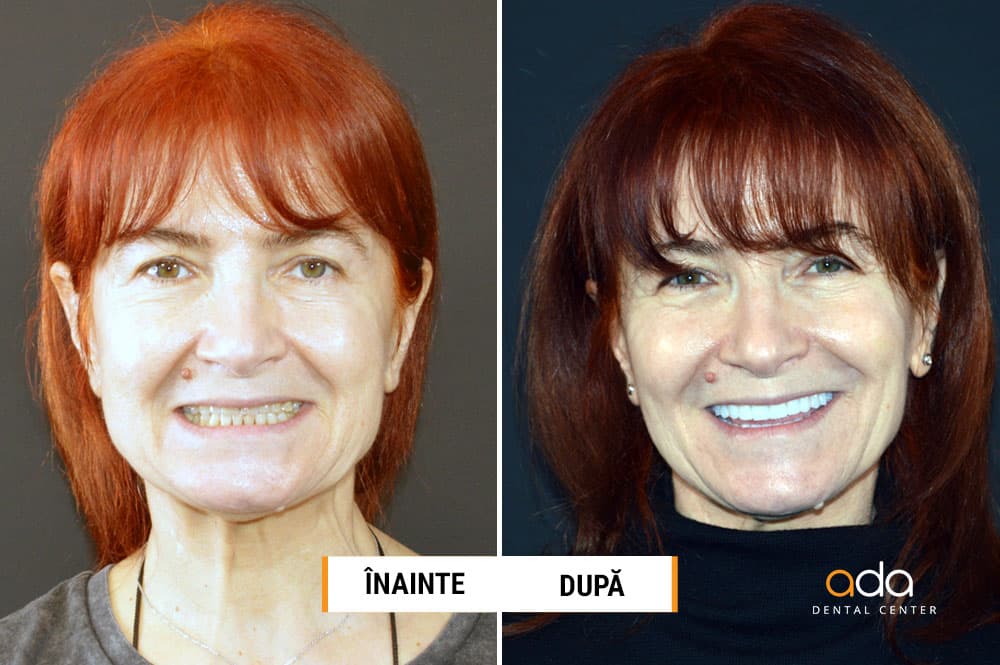 DSD — Rejuvenarea zâmbetului cu fațete — imagine 1