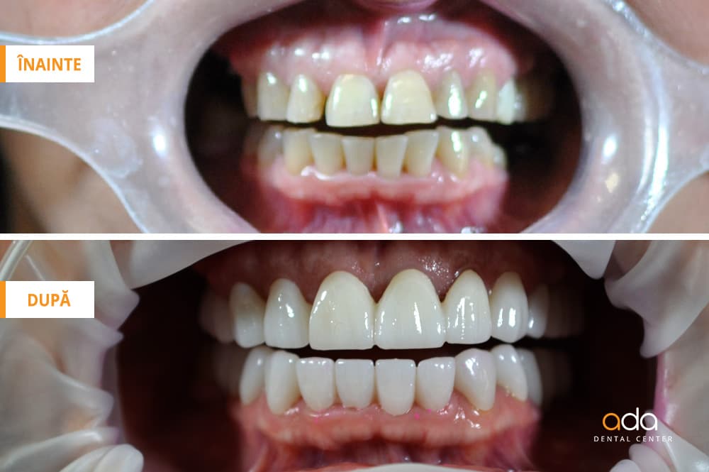 Restaurare totală a arcadelor dentare — imagine 1