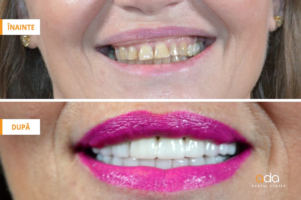 Restaurare totală a arcadelor dentare — imagine 2